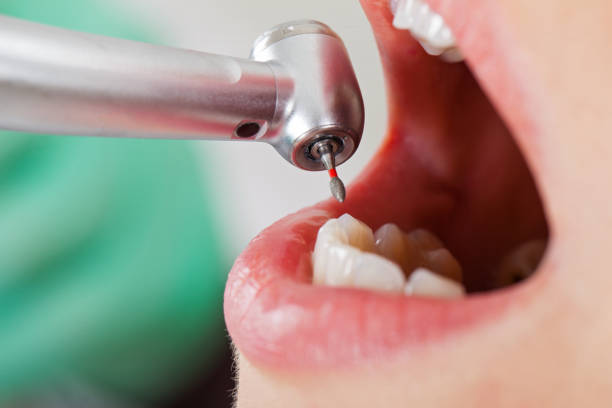 Best Emergency Treatment for Dental Infections or Abscesses in Frenchtown, NJ